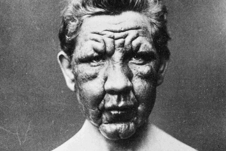 Lepra není jen starověkou nemocí, stále je po světě rozšířená