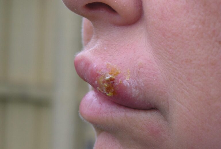 Opary na rtech bolí, svědí a kazí náladu. Pomoci může česnek, pasta i led, říkají babské rady