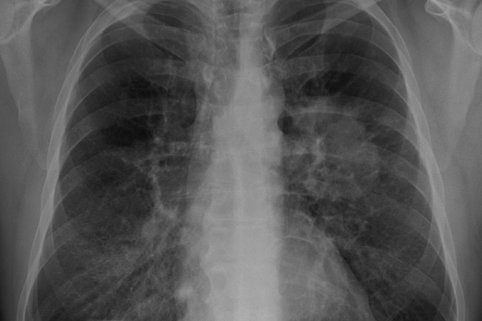 Lung_Cancer_on_Chest_X-Ray | ReadZone