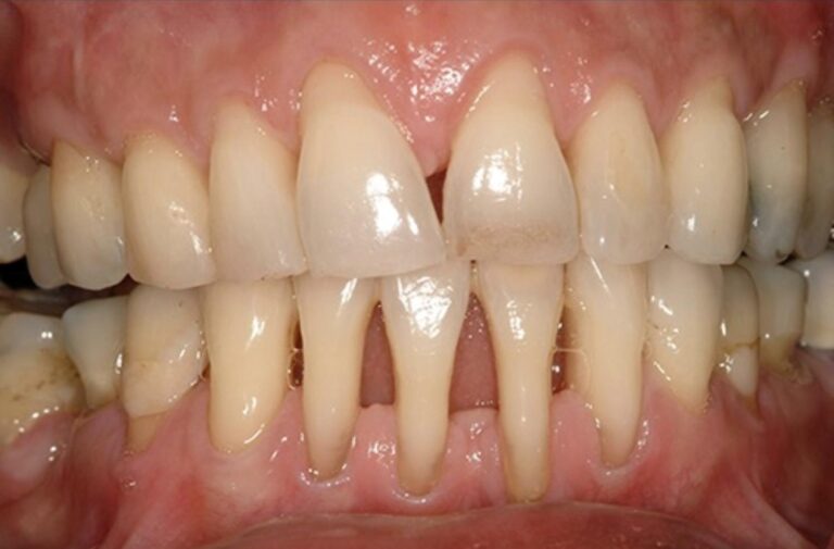 Drahé pasty vás nespasí. V boji s ustupujícími dásněmi funguje spolehlivě jen jedna věc