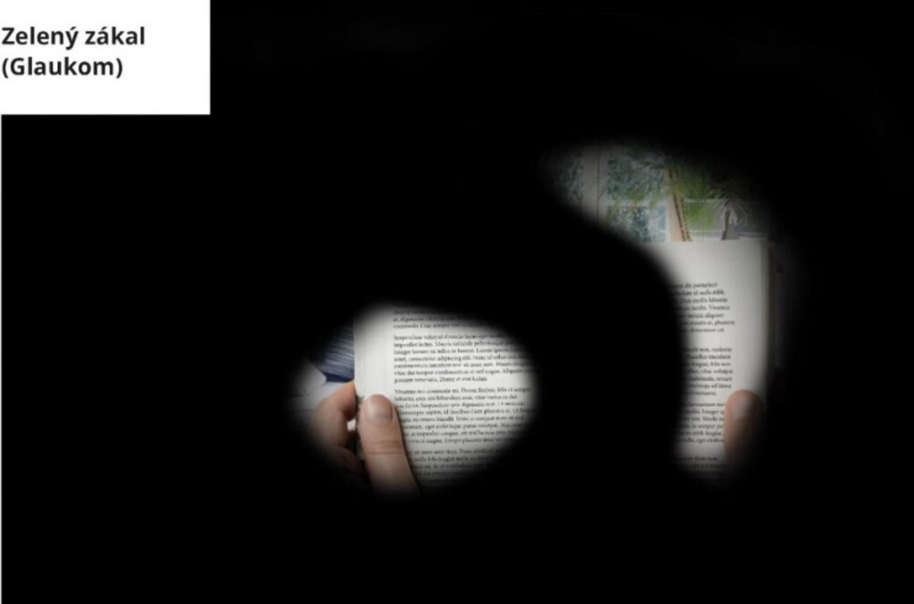 Takto vidí lidé se zeleným zákalem, FOTO: Petra Ďurčíková/PearMedia/Gemini