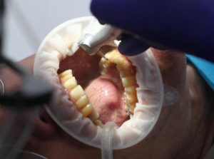 Konec amalgámu, FOTO: Pixabay.com